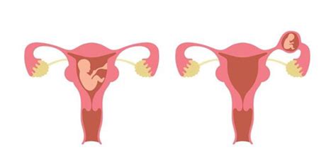 Diagram dat een buitenbaarmoederlijke zwangerschap illustreert