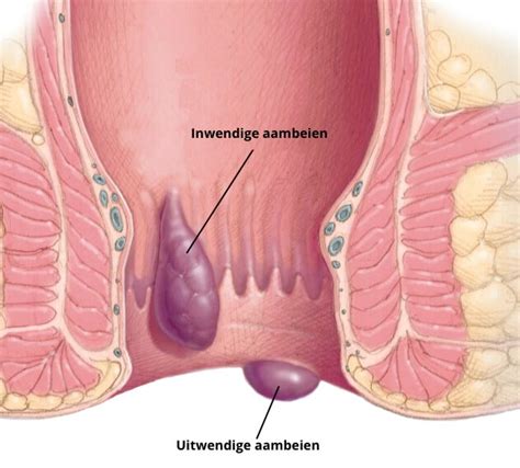 Illustratie van de anatomie van de anus met inwendige en uitwendige aambeien