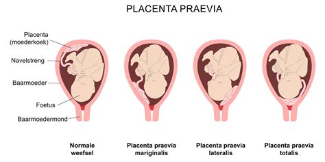 Illustratie van de verschillende oorzaken van bloedverlies in de late zwangerschap, zoals placenta praevia, loslating van de placenta en begin van de bevalling.