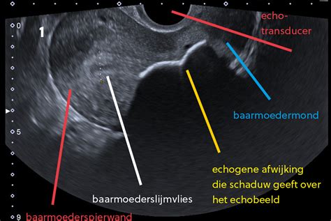 Schematische weergave van een echoscopie van de baarmoeder en placenta.