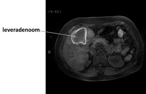 Schema van de diagnostische stappen bij verdenking op een leveradenoom, beginnend bij lichamelijk onderzoek en bloedonderzoek, gevolgd door beeldvormende technieken zoals echo, CT en MRI.