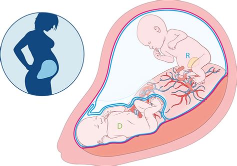 Illustratie van het tweelingtransfusiesyndroom (TTS), waarbij de bloedcirculatie tussen de baby's onevenwichtig is.