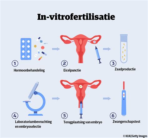 Schema van de IVF-behandeling in 5 stappen.