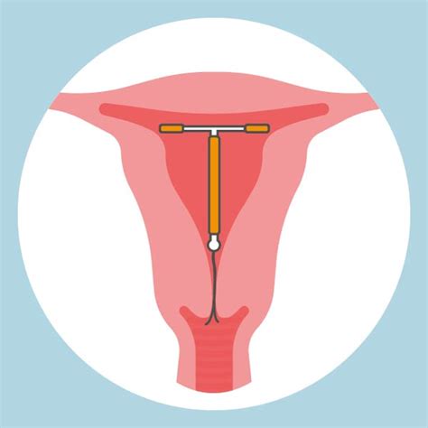 Illustratie van een koperspiraal in de baarmoeder