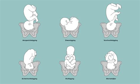 illustratie van een baby in stuitligging