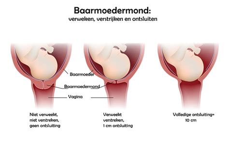 Illustratie van de baarmoeder met weeënactiviteit en ontsluiting van de baarmoedermond.