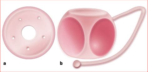 Een afbeelding van een pessarium, een medisch hulpmiddel voor de baarmoedermond.