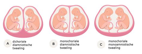 Illustratie van een tweelingzwangerschap en hoe de NIPT het geslacht kan bepalen.