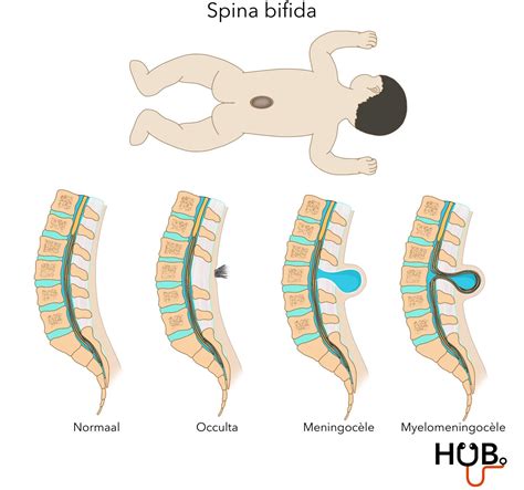 Infographic die de diverse mogelijke gevolgen van spina bifida illustreert, van motorische beperkingen tot blaas- en darmproblemen.