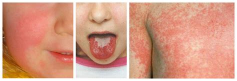 foto van een kind met de kenmerkende aardbeientong bij roodvonk