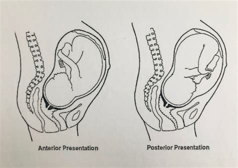 Diagram dat de 'sterrenkijker' positie van de baby illustreert, met het achterhoofd naar de rug van de moeder.