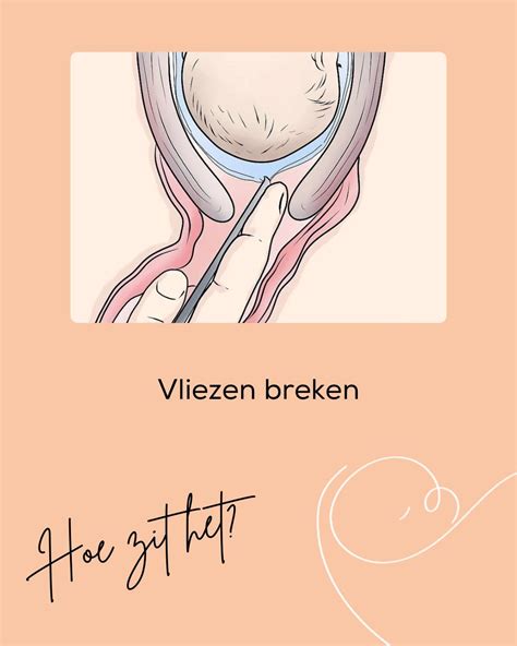 illustratie van gebroken vliezen met helder vruchtwater