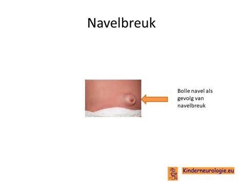 Diagram dat een navelbreuk illustreert