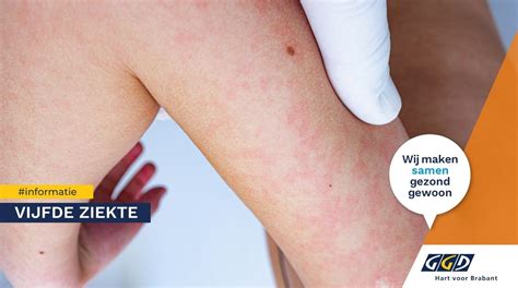 Illustratie van de vlindervormige uitslag van de vijfde ziekte