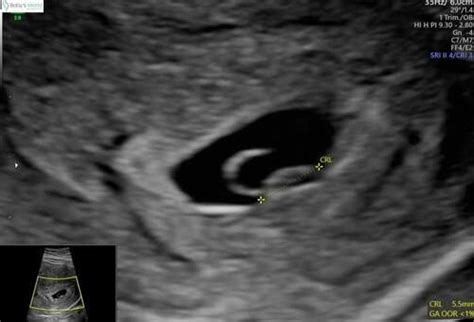 echo van een vruchtzakje met een klein embryo en een dooierzak