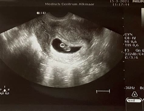 voorbeeld van een echo van 7 weken zwangerschap met zichtbaar embryo