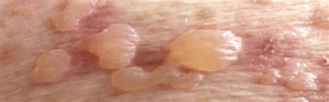 Illustratie van handen en voeten met rode vlekjes en blaasjes