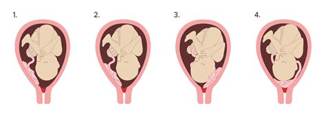 Schematische weergave van de positie van de baby in het geboortekanaal tijdens de persfase.