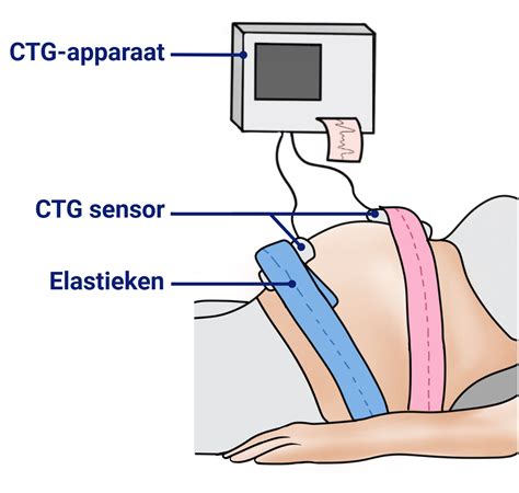 Illustratie van een CTG-apparaat
