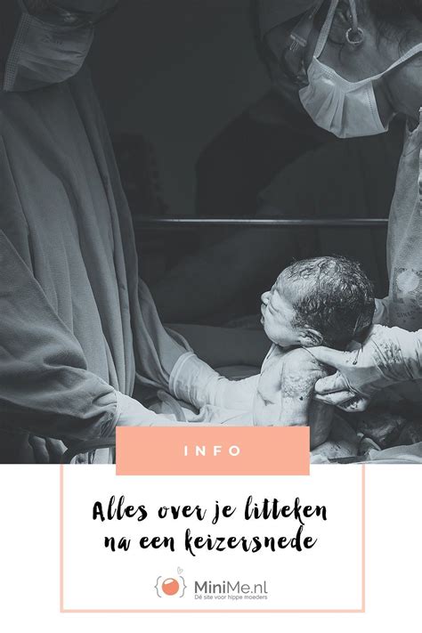 Illustratie van de baarmoeder met litteken na keizersnede