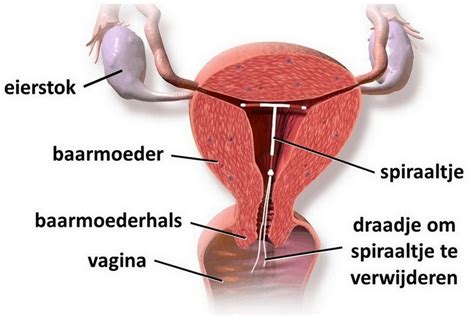 een schematische weergave van het inbrengen van een spiraaltje in de baarmoeder
