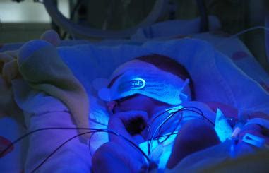 Baby die fototherapie ondergaat onder speciale blauwe lampen, met beschermende oogkapjes.