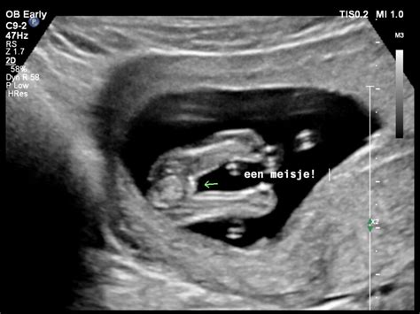 illustratie van een echografie waarbij het geslacht van de baby te zien is