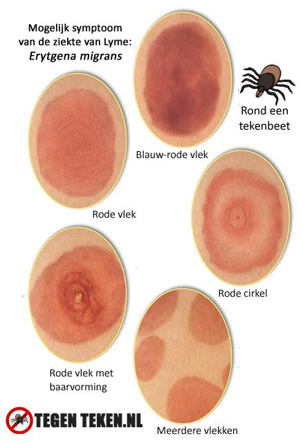 Illustratie van erythema migrans (ringvormige huiduitslag).
