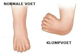 babyvoetje met klompvoet afwijking