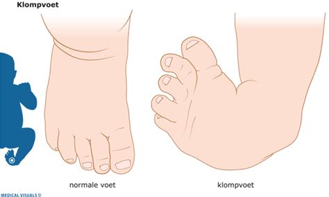 Echo van een foetus waarbij een klompvoet zichtbaar is