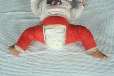 Baby met een gipsbroek die de klompvoet corrigeert