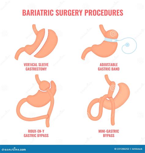Illustratie van verschillende chirurgische ingrepen voor borstcorrectie na zwangerschap.