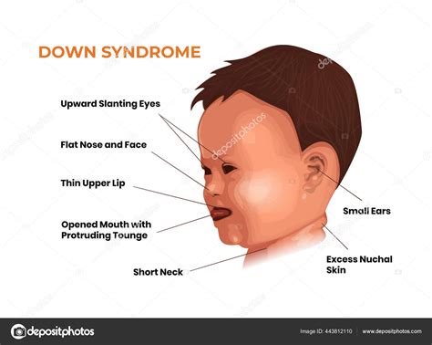 Illustratie van typische uiterlijke kenmerken van syndroom van Down.