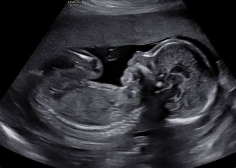 Beeld van een 20-wekenecho, waarop de baby en de belangrijkste organen te zien zijn.