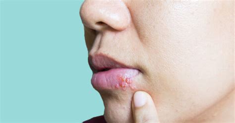 Illustratie van blaasjes in de mond van een kind