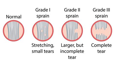 Schema dat de verschillende gradaties van eiwithydrolyse illustreert: intact, partieel gehydrolyseerd, intensief gehydrolyseerd.