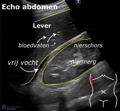 Inwendige echo van de baarmoederhals