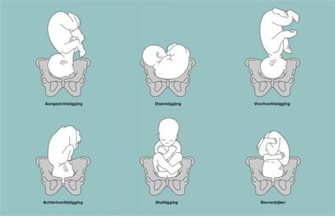 Informatieve illustratie die de 'ideale' baby-ligging vergelijkt met de sterrenkijker positie.