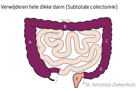 Anatomische illustratie van de dikke darm met aanduiding van mogelijke vernauwde gebieden.
