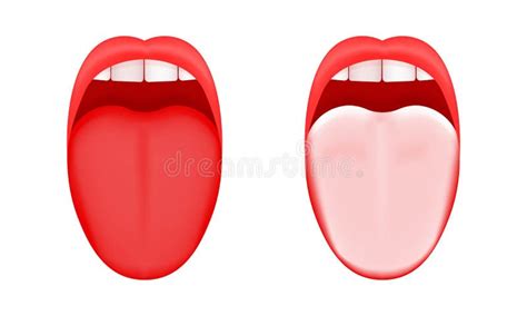 Vergelijking van een normale tongvorm en een tong met een korte tongriem, waarbij de tongvorm bij het omhoog steken een hartjesvorm vertoont.