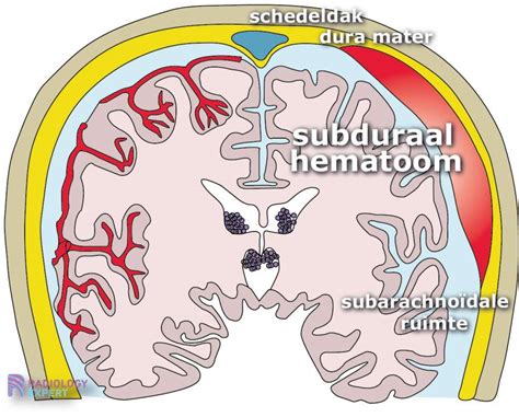 Illustratie van de hersenkamers (ventrikels) met een intraventriculaire bloeding