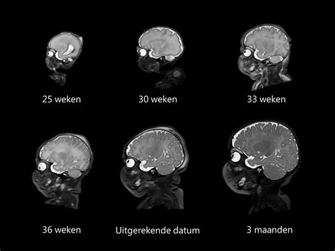 Infographic die de hersenontwikkeling en mogelijke problemen bij prematuren weergeeft