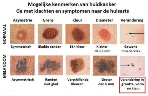 illustratie van verschillende soorten moedervlekken en hun kenmerken
