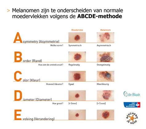 infographic over de ABCDE-methode voor het beoordelen van moedervlekken