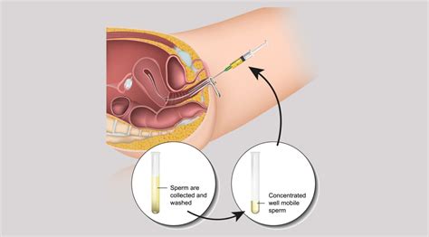 Illustratie van het proces van intra-uteriene inseminatie, met pijlen die de weg van de zaadcellen naar de baarmoederholte tonen.
