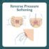 Illustratie van de RPS-techniek (reverse pressure softening)