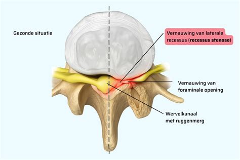 Illustratie die de oorzaken van ischias toont, zoals een hernia, spinale stenose en triggerpoints.
