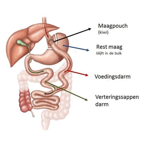 Risico's op galstenen en darmverdraaiing na maagverkleining