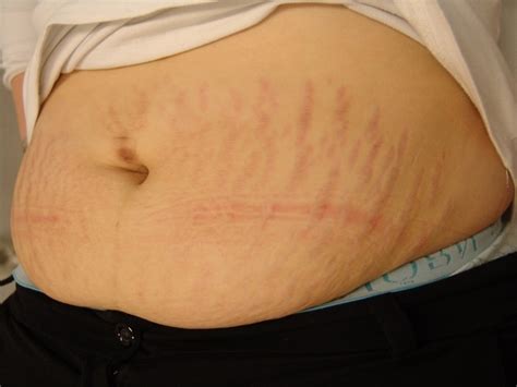 voorbeeld van striae op de buik