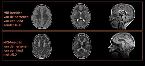 Illustratie van een MRI-scanner en een voorbeeld van een hersenscan.